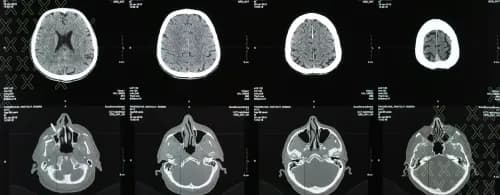 Exploring the link between hearing loss, dementia & Alzheimer’s Disease